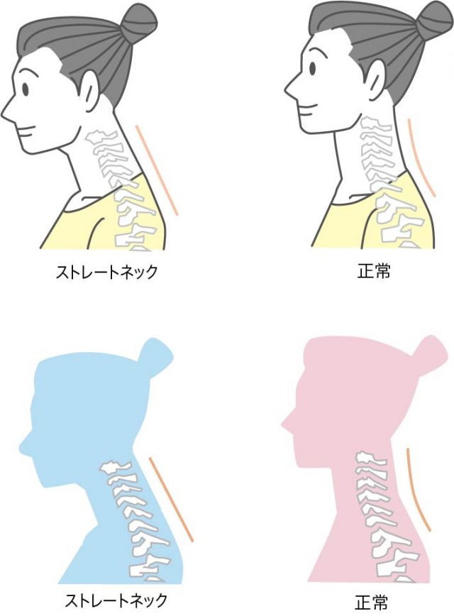 ストレートネックとは