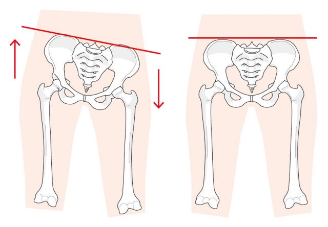 骨盤の歪みの原因